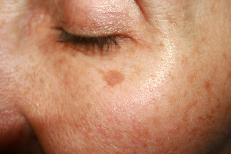 close up of age spots on face