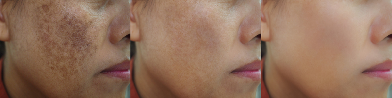 pigmentation reduction images