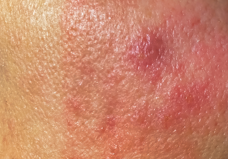 close up of rosacea