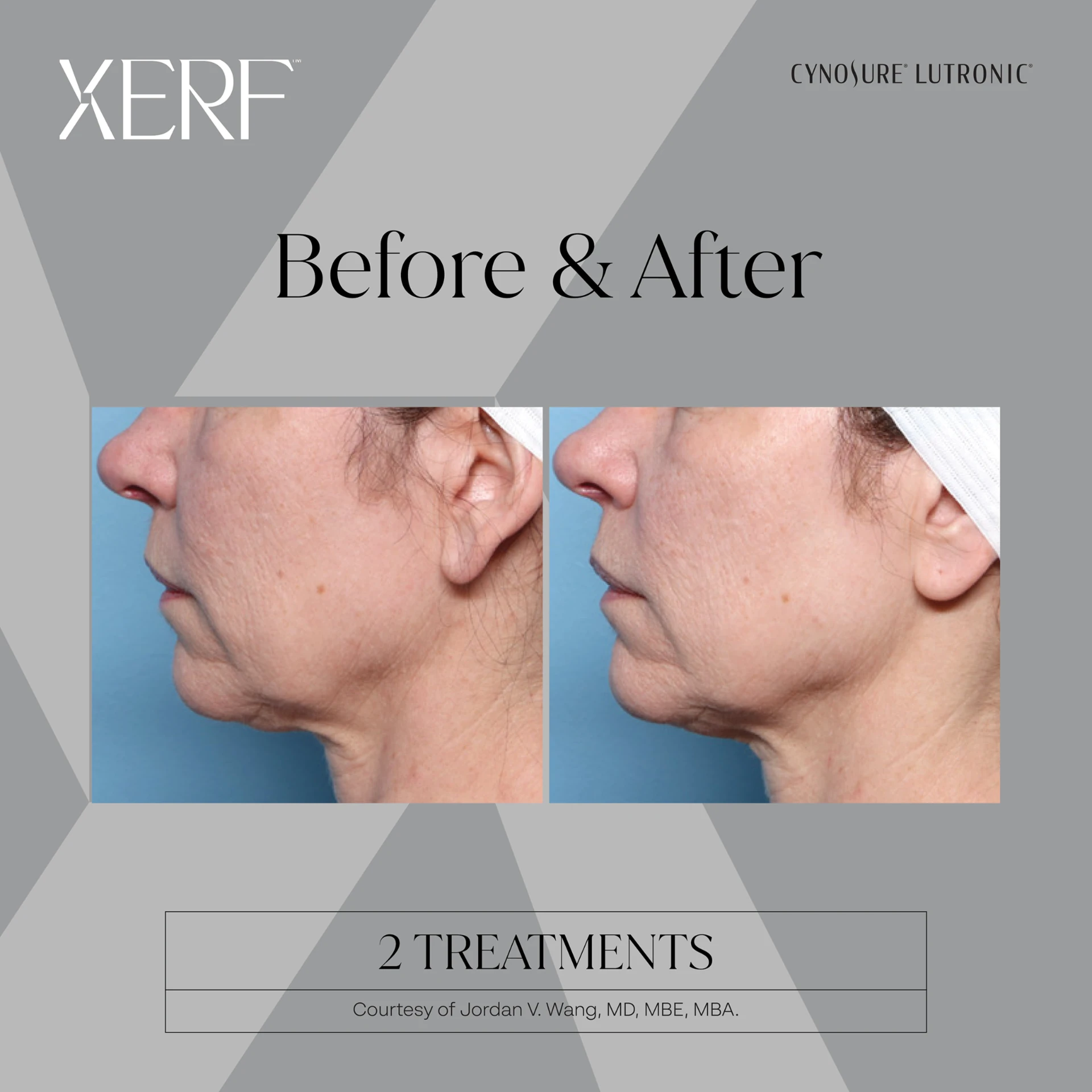 The Centre for Dermatology|Xerf – Skin Tightening