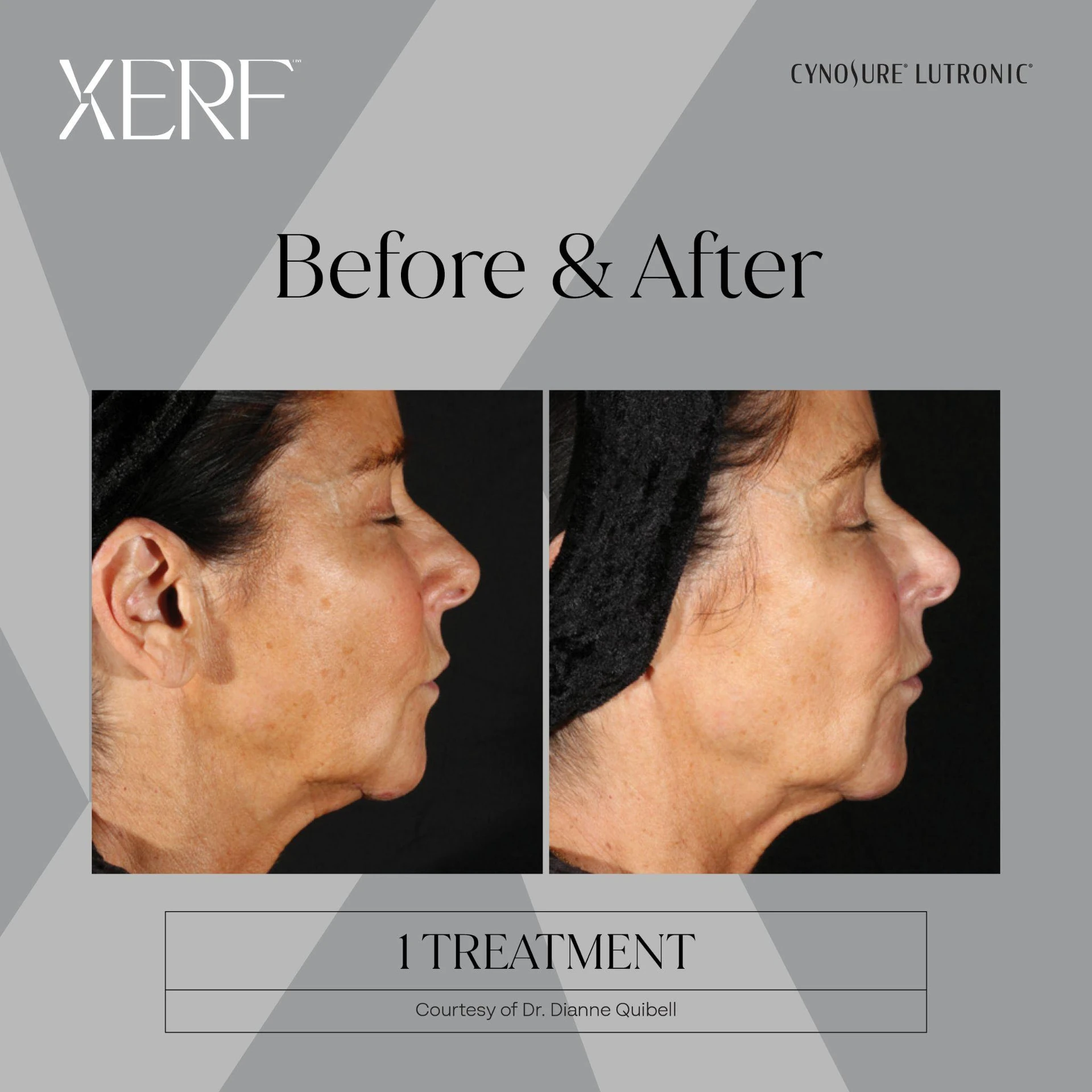 The Centre for Dermatology|Xerf – Skin Tightening