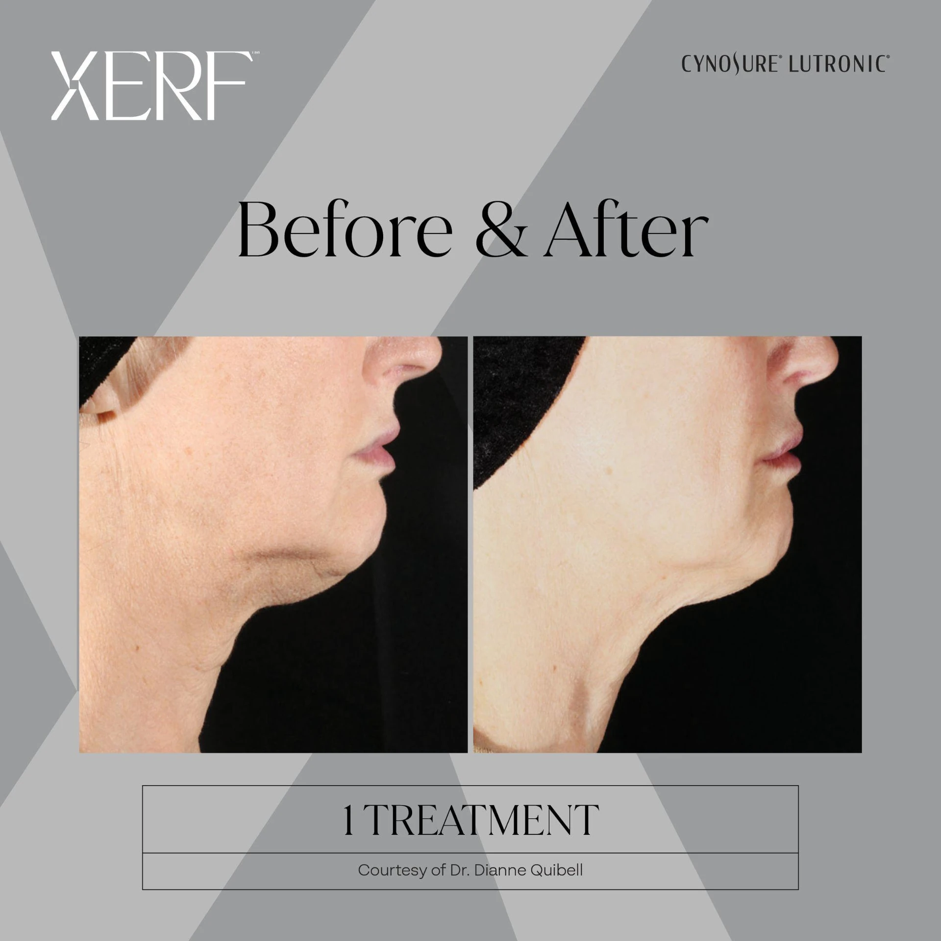 The Centre for Dermatology|Xerf – Skin Tightening