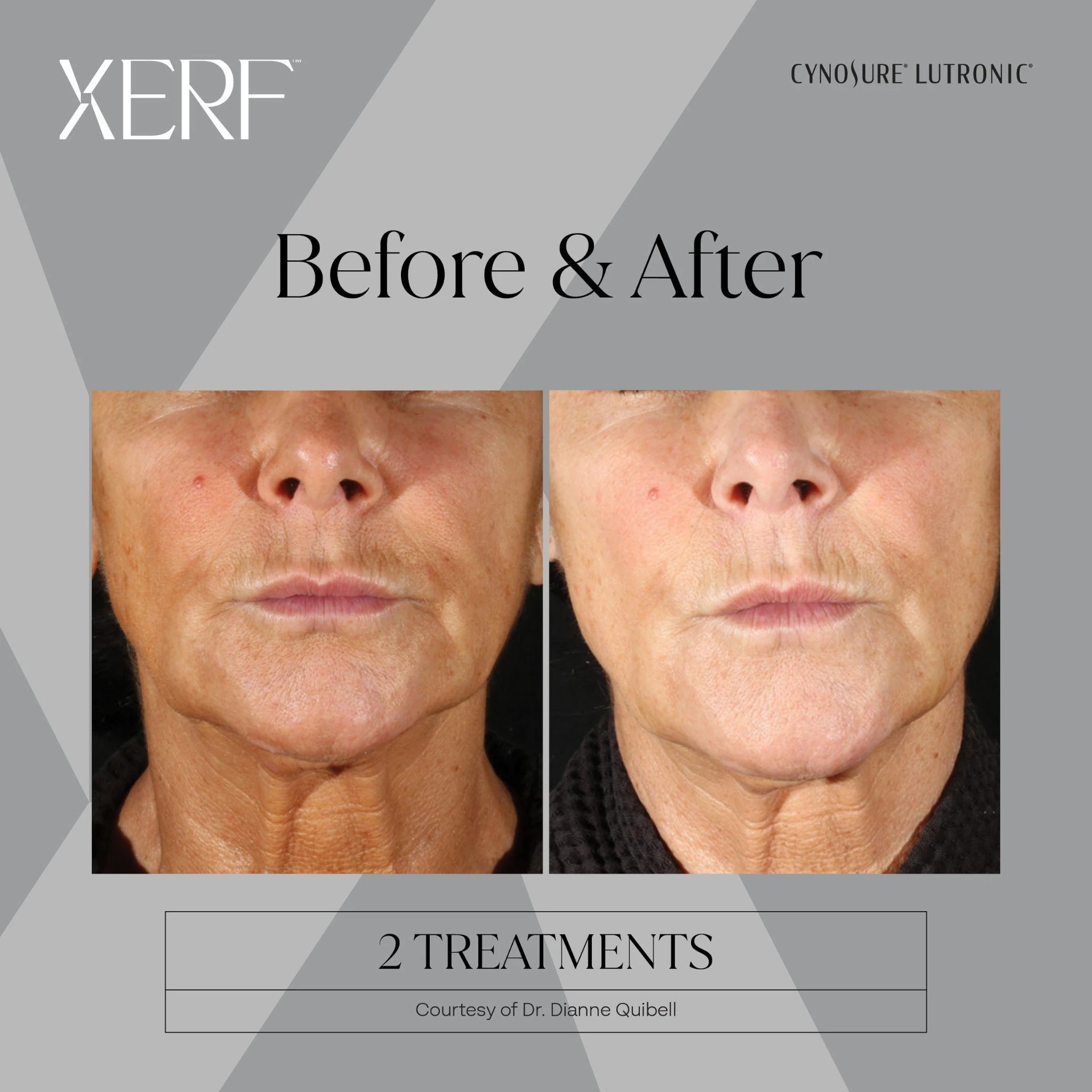 The Centre for Dermatology|Xerf – Skin Tightening