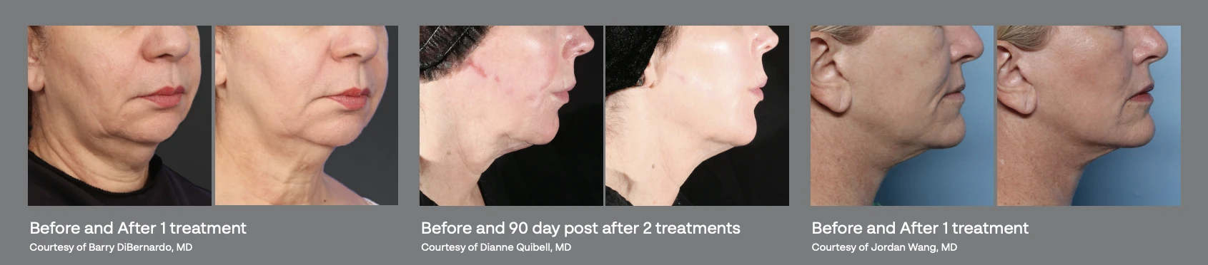 XERF Before and After Collage