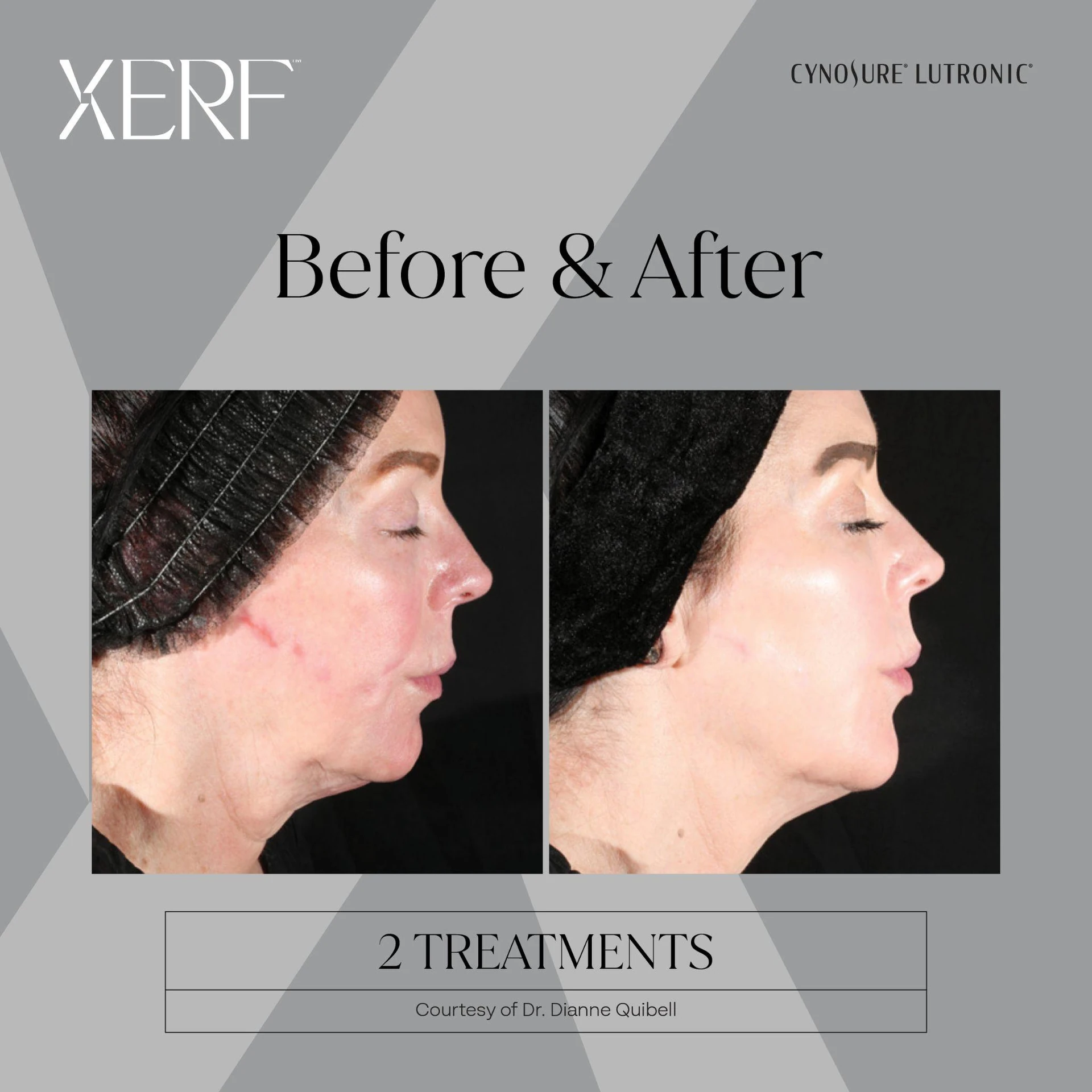 The Centre for Dermatology|Xerf – Skin Tightening