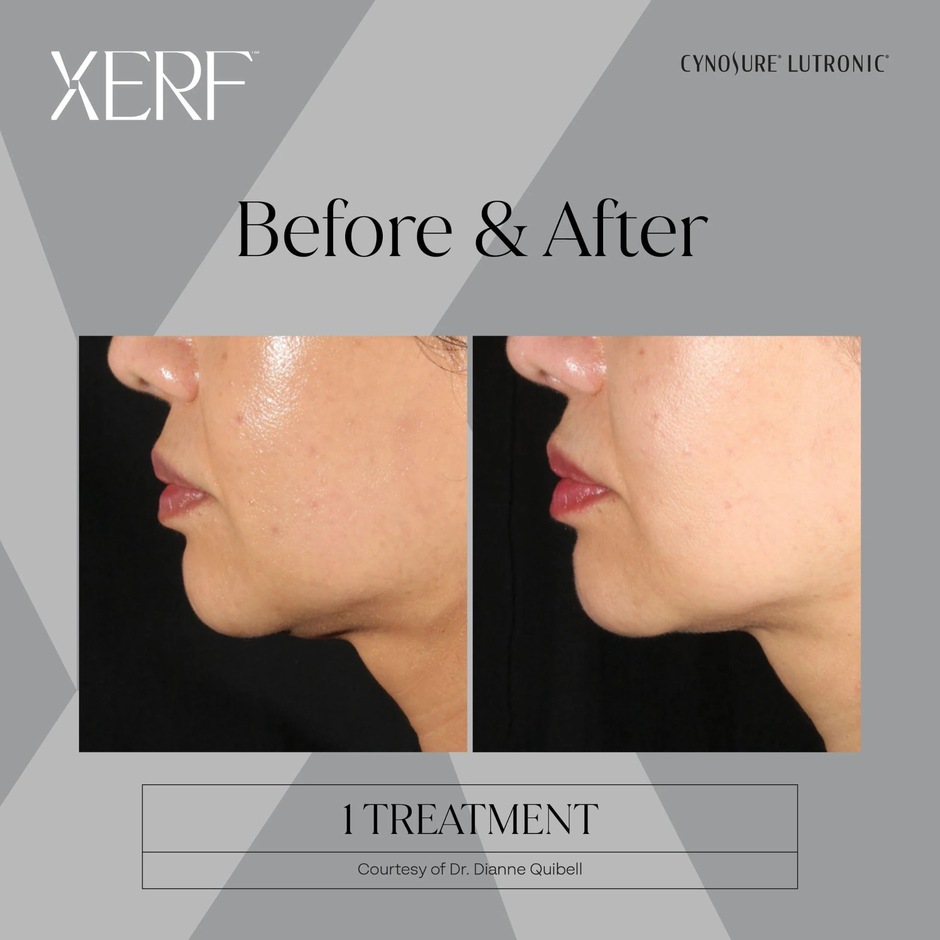 The Centre for Dermatology|Xerf – Skin Tightening