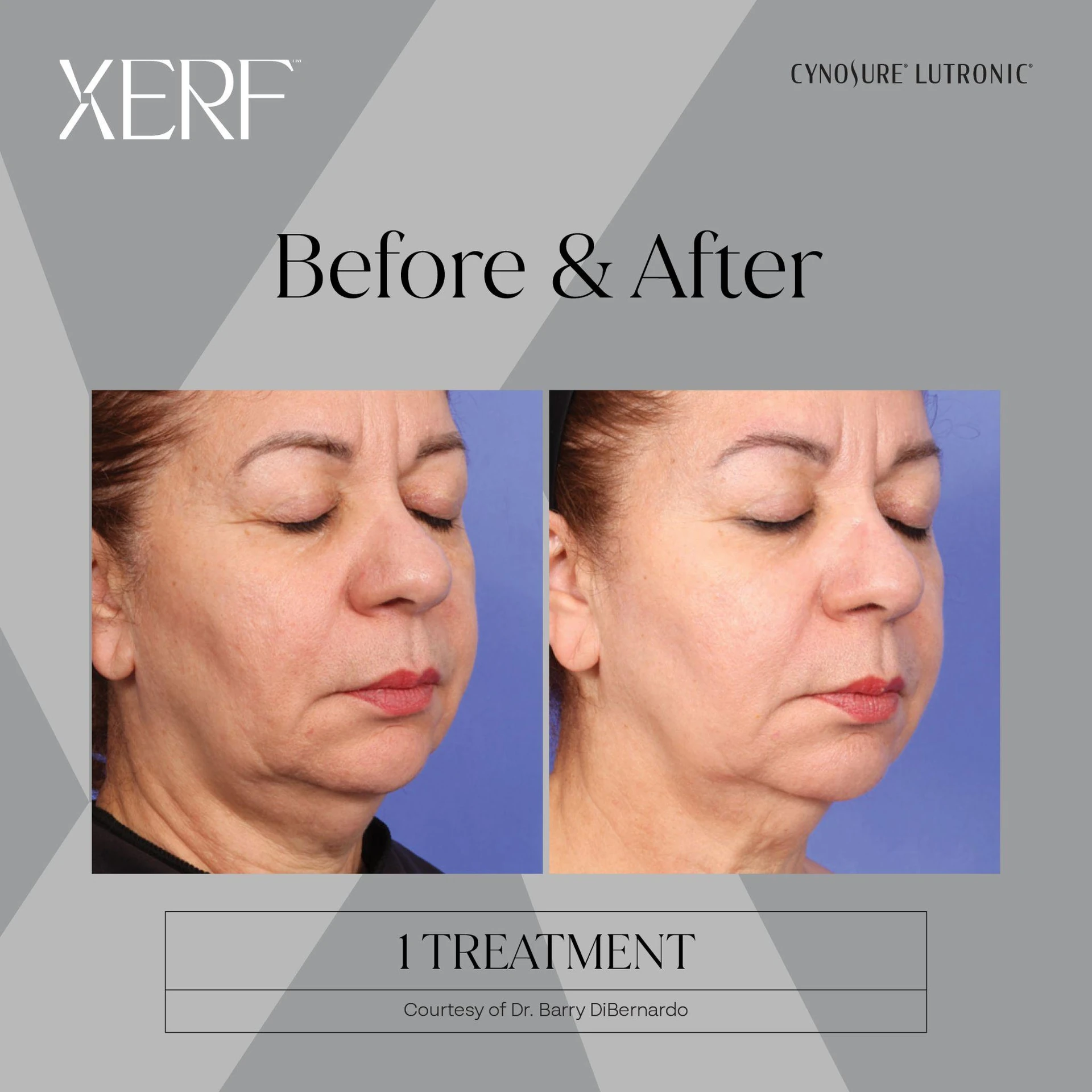 The Centre for Dermatology|Xerf – Skin Tightening