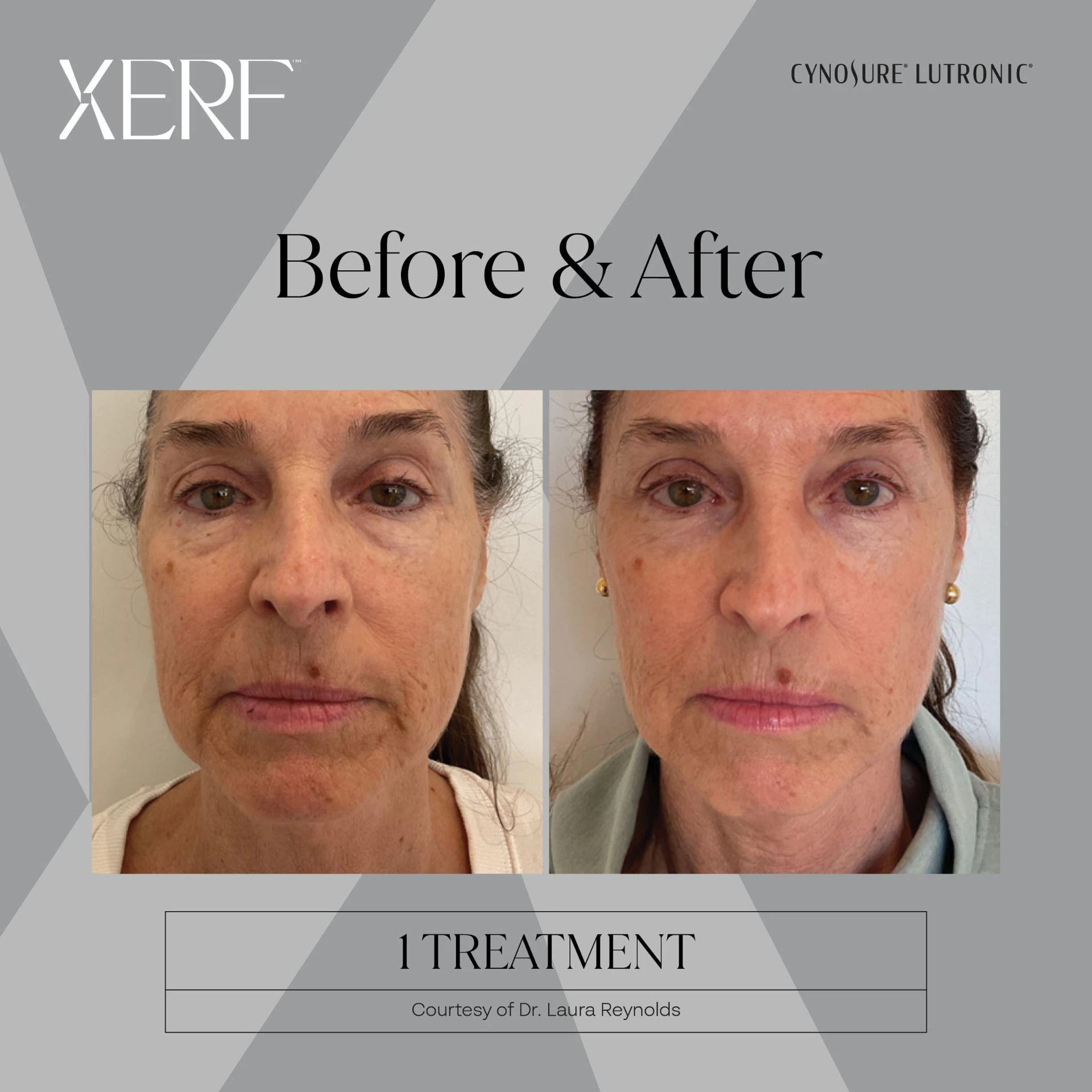 The Centre for Dermatology|Xerf – Skin Tightening