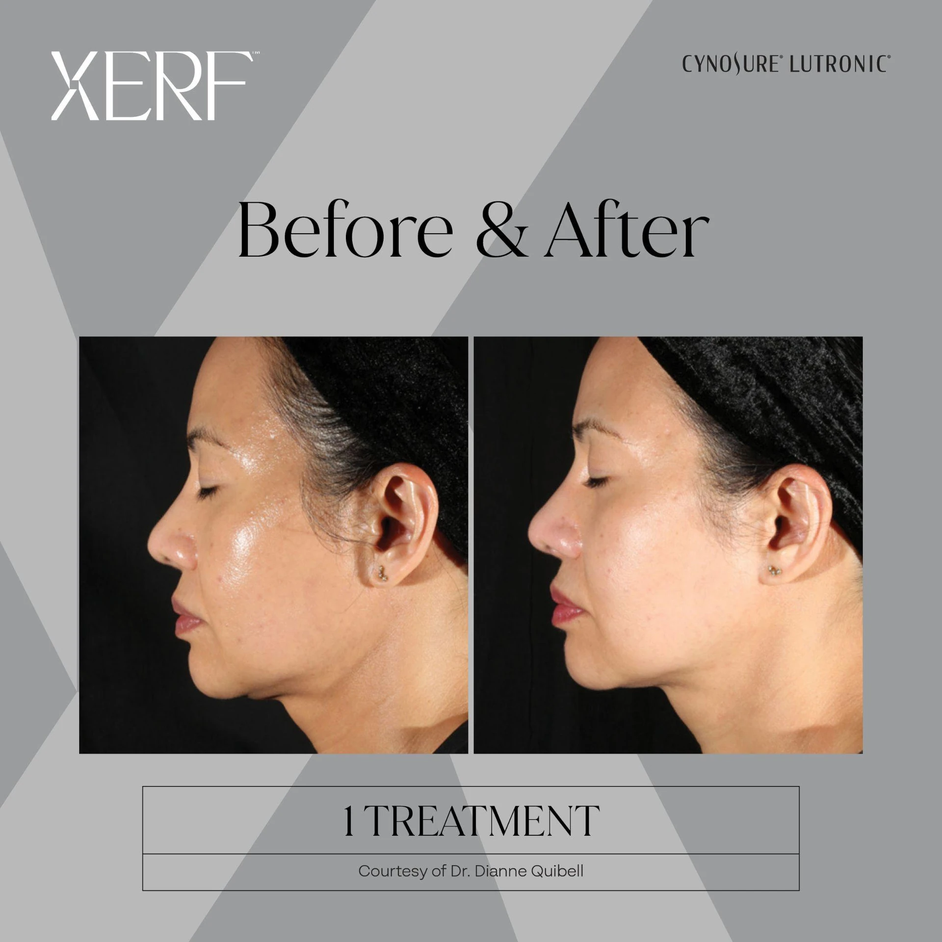 The Centre for Dermatology|Xerf – Skin Tightening