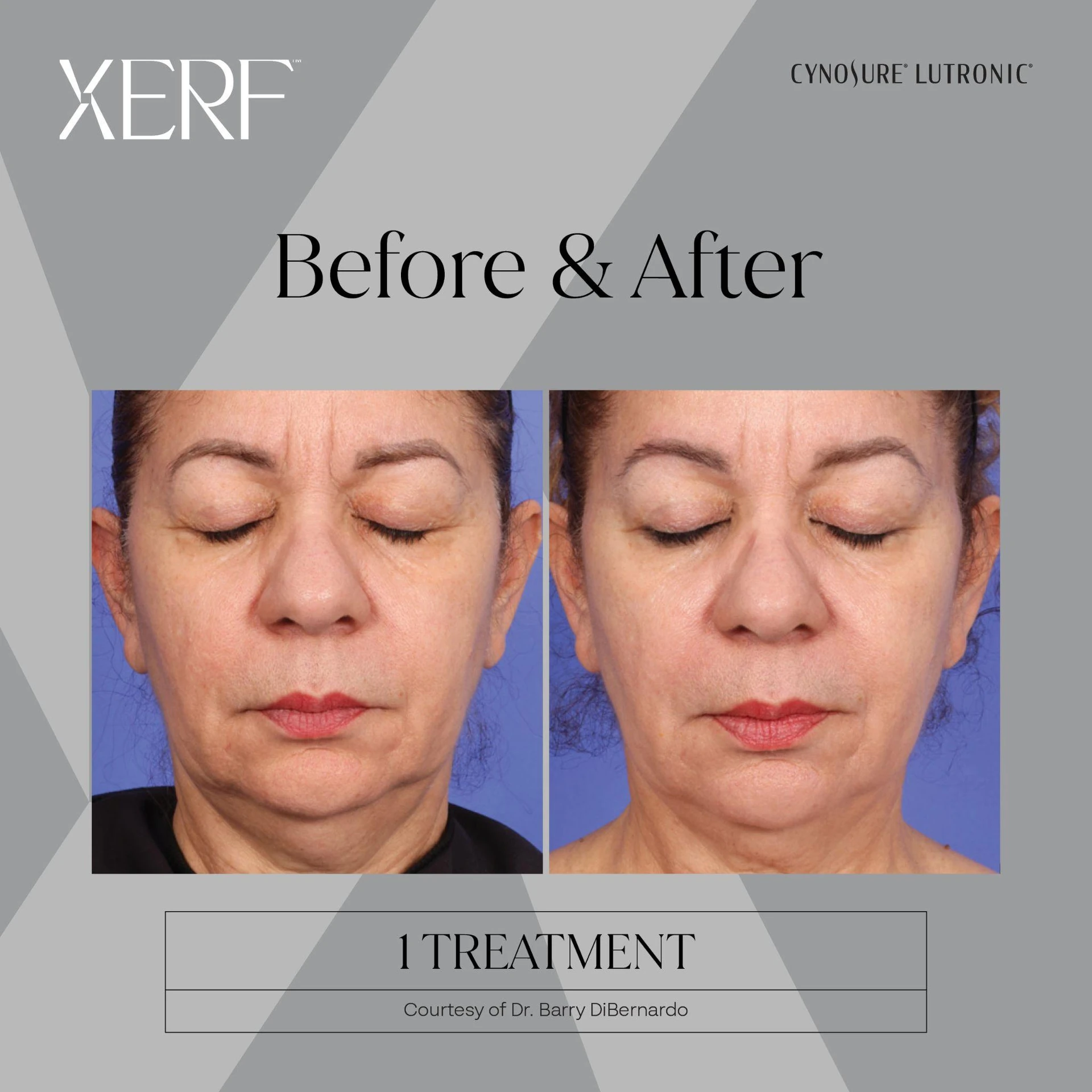 The Centre for Dermatology|Xerf – Skin Tightening