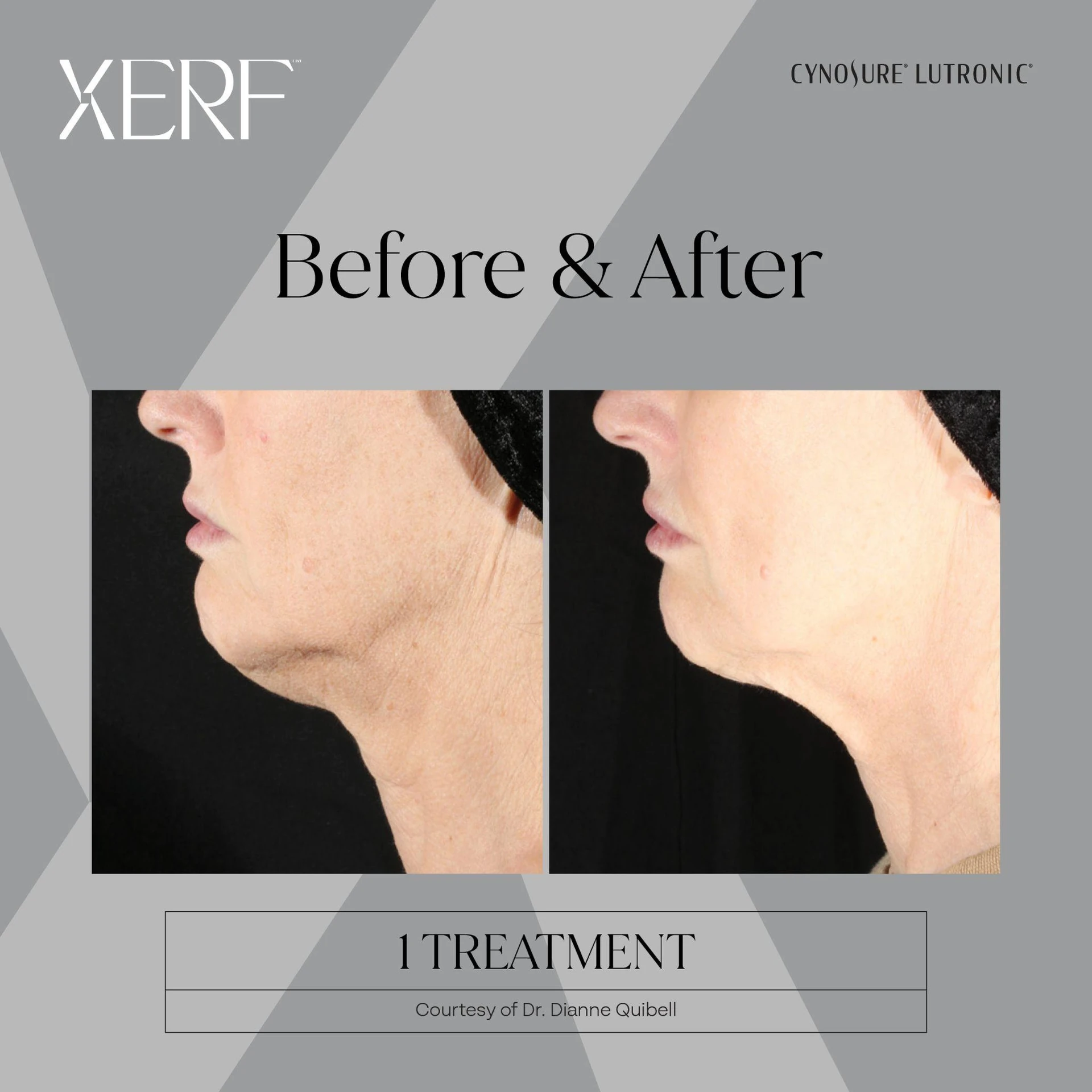 The Centre for Dermatology|Xerf – Skin Tightening